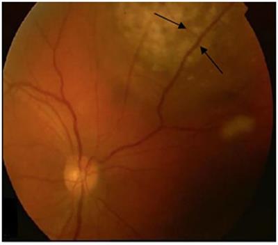 Case report: Immunotherapy inducing unexpected overall survival in choroidal melanoma: about a case